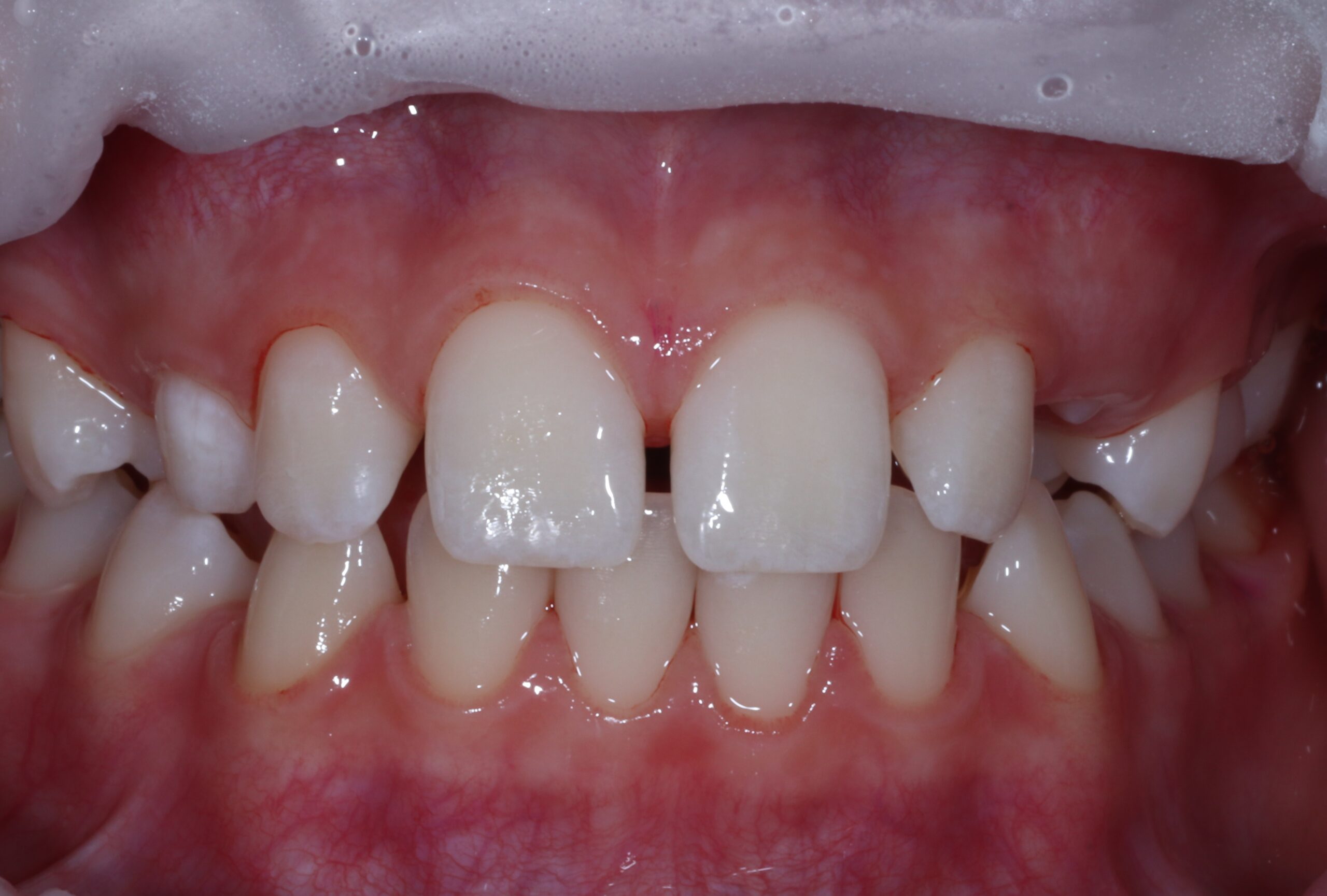 After image