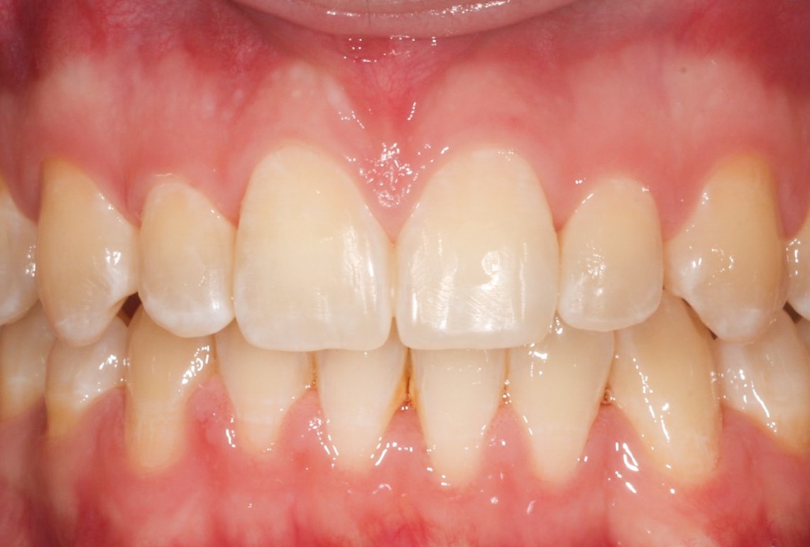 After image